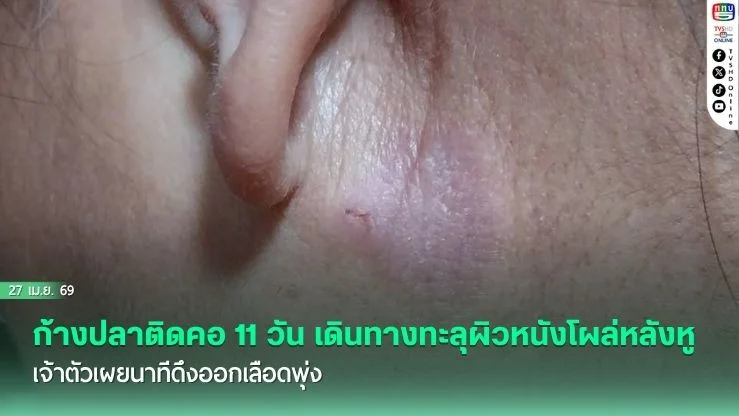อุทาหรณ์สุดแปลก! ก้างปลาติดคอ 11 วัน เดินทางทะลุผิวหนังโผล่หลังหู เจ้าตัวเผยนาทีดึงออกเลือดพุ่ง