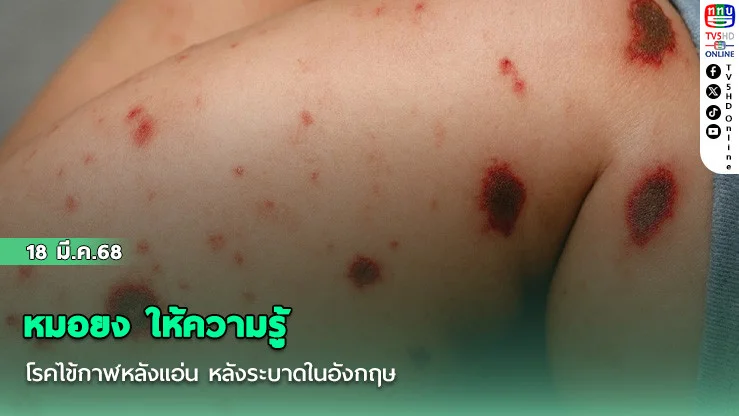 หมอยง ให้ความรู้ โรคไข้กาฬหลังแอ่น หลังระบาดในอังกฤษ