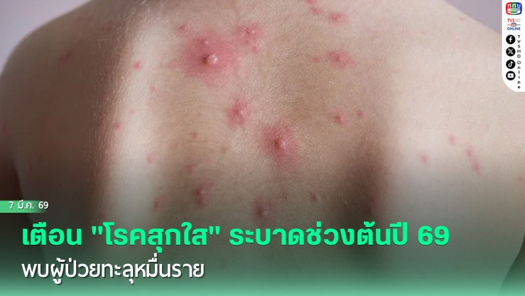 กรมควบคุมโรคเตือน "โรคสุกใส" ระบาดช่วงต้นปี 69 พบผู้ป่วยทะลุหมื่นราย