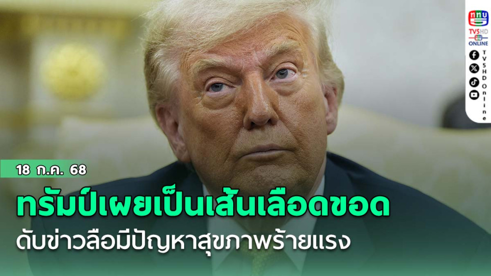 ทรัมป์ขาบวม-มือช้ำ เผยเป็นเส้นเลือดขอด ดับข่าวลือมีปัญหาสุขภาพร้ายแรง