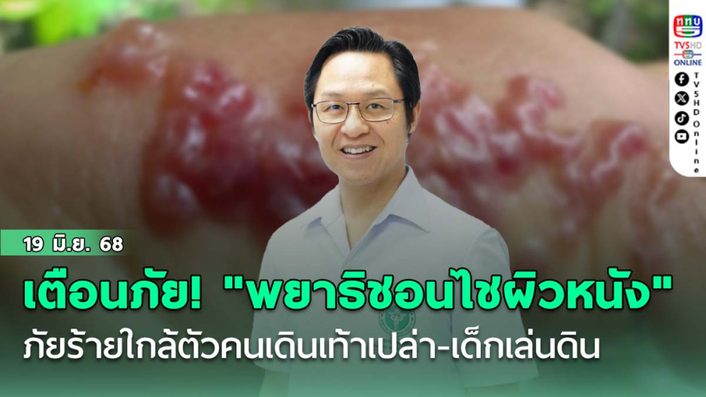 สถาบันโรคผิวหนัง เตือนภัย! "พยาธิชอนไชผิวหนัง" ภัยร้ายใกล้ตัวคนเดินเท้าเปล่า-เด็กเล่นดิน