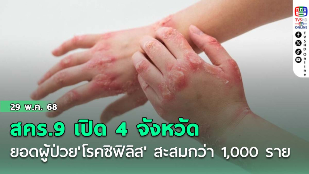 สคร.9 เปิด 4 จังหวัด ยอดผู้ป่วย'โรคซิฟิลิส' สะสมกว่า 1,000 ราย
