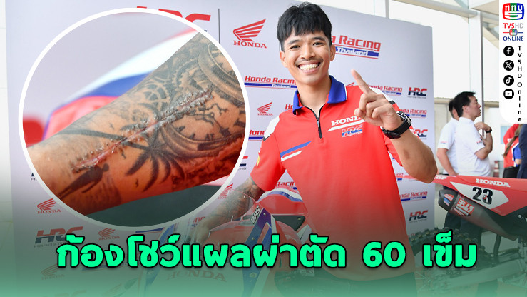 "ก้อง สมเกียรติ" ผ่าตัด 60 เข็ม ลุยซูเปอร์ไบค์โลก