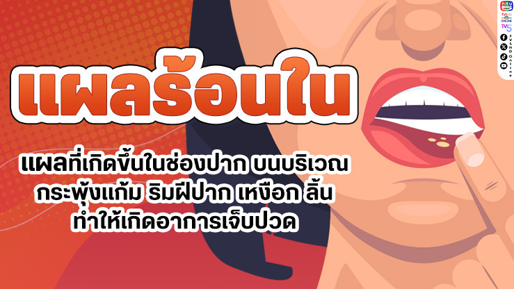 เป็นร้อนในบ่อยๆ ใช่ไหม? มาทําความเข้าใจสาเหตุและวิธีดูแลกัน!