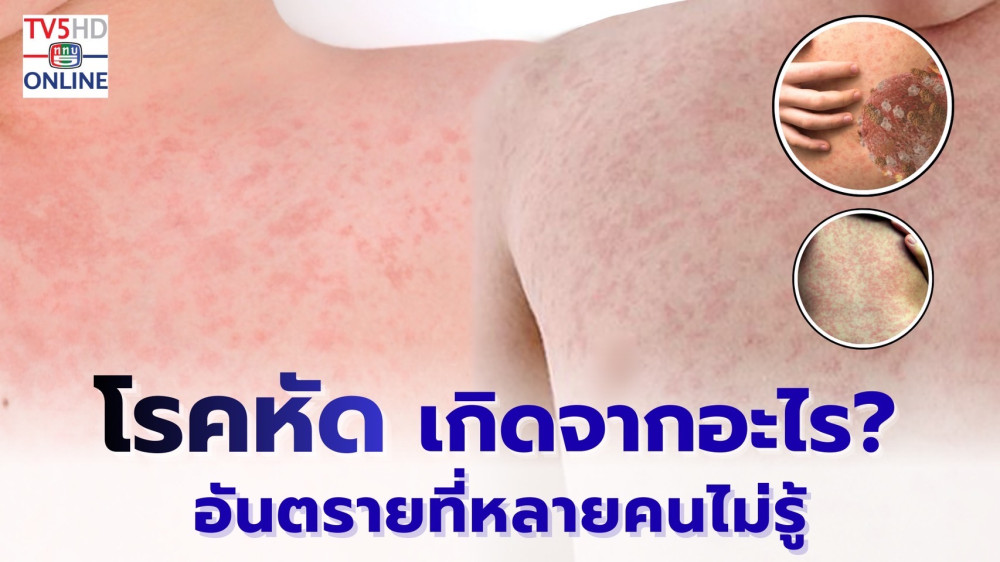 โรคหัดไม่ใช่เรื่องไกลตัว!