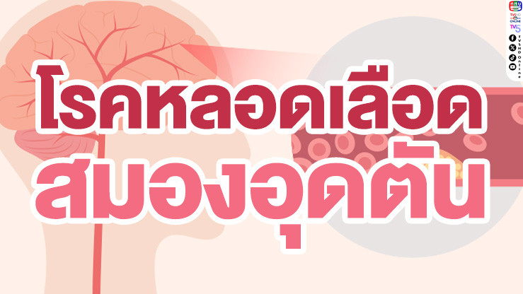 รู้ทัน! โรคหลอดเลือดสมองอุดตัน (Stroke) สัญญาณเตือนที่ต้องรีบไปหาหมอ ป้องกันก่อนอัมพาต!