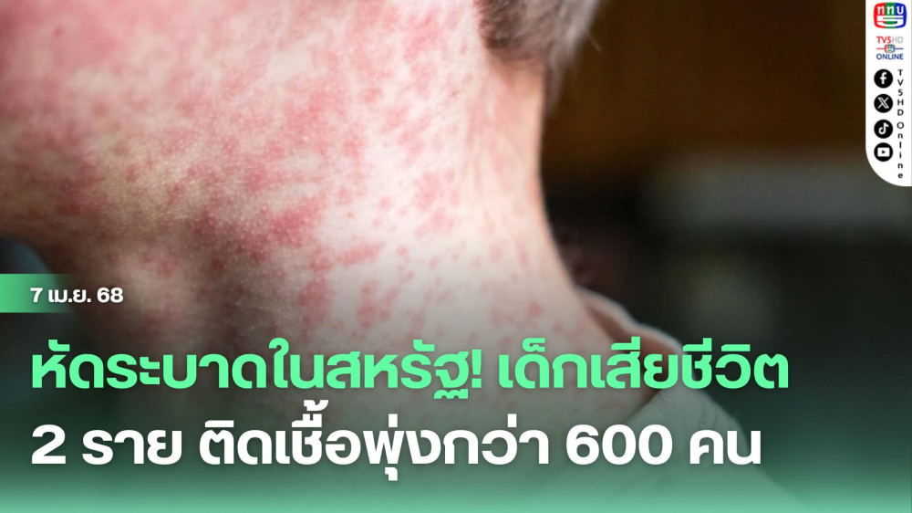 หัดระบาดในสหรัฐ! เด็กเสียชีวิต 2 ราย ติดเชื้อพุ่งกว่า 600 คน