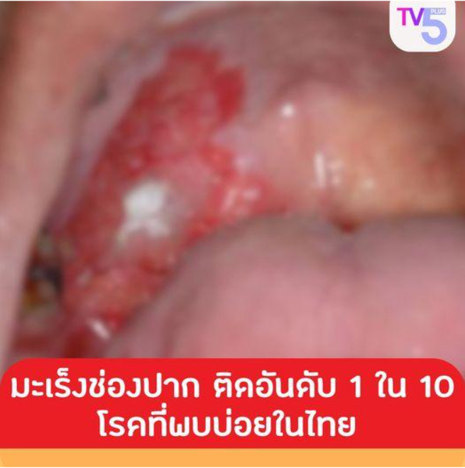มะเร็งช่องปากเป็นโรคที่ติดอันดับ 1 ใน 10 ที่พบได้บ่อยในประเทศไทย
