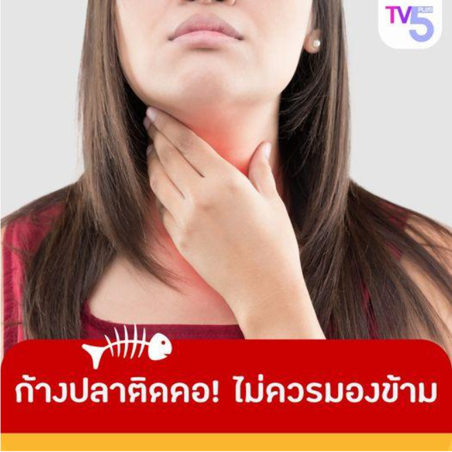 รู้ทัน! วิธีปฐมพยาบาลเมื่อก้างปลาติดคอ