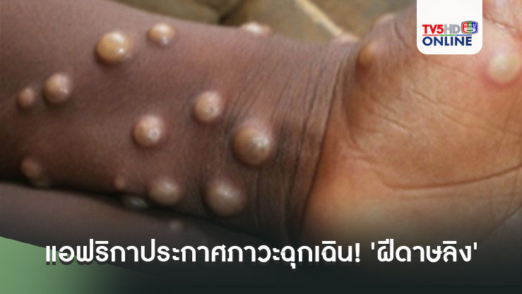 แอฟริกาประกาศภาวะฉุกเฉิน! 'ฝีดาษลิง'ระบาดข้ามชายแดน กระทบแล้วหลายพันชีวิต